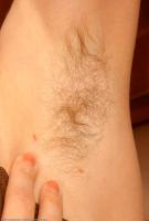 ATK hairy  in mature and hairy