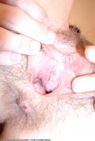 ATK hairy  in mature and hairy