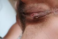 ATK hairy  in mature and hairy