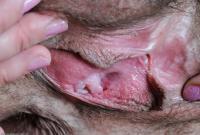 ATK hairy  in mature and hairy