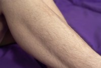 ATK hairy  in young and hairy