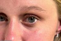 ATK hairy  in mature and hairy