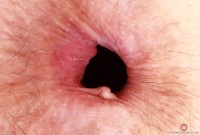 ATK hairy  in mature and hairy