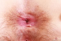 ATK hairy  in mature and hairy
