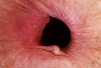 ATK hairy  in mature and hairy