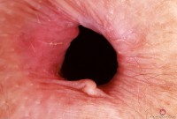 ATK hairy  in mature and hairy