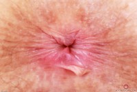 ATK hairy  in mature and hairy