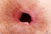 ATK hairy  in mature and hairy