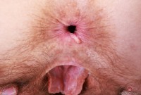 ATK hairy  in mature and hairy