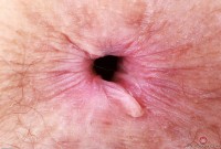 ATK hairy  in mature and hairy