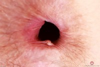 ATK hairy  in mature and hairy