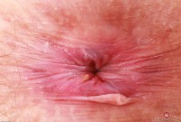 ATK hairy  in mature and hairy