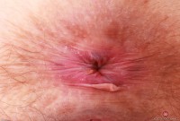ATK hairy  in mature and hairy