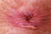 ATK hairy  in mature and hairy