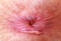 ATK hairy  in mature and hairy