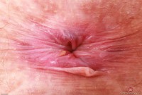 ATK hairy  in mature and hairy