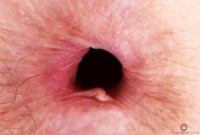 ATK hairy  in mature and hairy