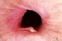 ATK hairy  in mature and hairy