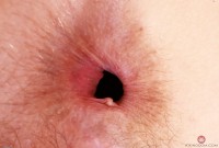 ATK hairy  in mature and hairy