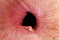 ATK hairy  in mature and hairy