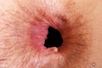 ATK hairy  in mature and hairy