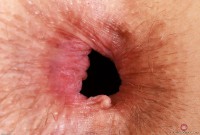 ATK hairy  in mature and hairy