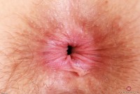ATK hairy  in mature and hairy