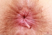 ATK hairy  in mature and hairy