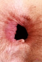 ATK hairy  in mature and hairy