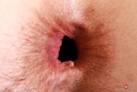 ATK hairy  in mature and hairy