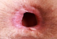 ATK hairy  in mature and hairy