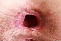 ATK hairy  in mature and hairy