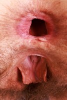 ATK hairy  in mature and hairy
