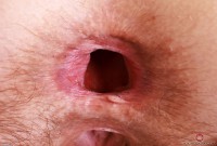 ATK hairy  in mature and hairy