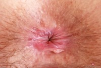 ATK hairy  in mature and hairy