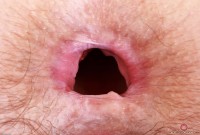 ATK hairy  in mature and hairy
