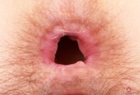 ATK hairy  in mature and hairy