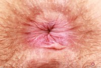 ATK hairy  in mature and hairy