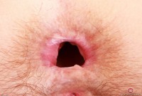 ATK hairy  in mature and hairy