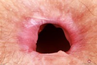 ATK hairy  in mature and hairy