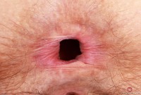 ATK hairy  in mature and hairy