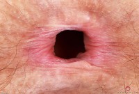 ATK hairy  in mature and hairy