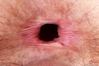 ATK hairy  in mature and hairy