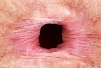 ATK hairy  in mature and hairy