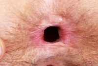 ATK hairy  in mature and hairy