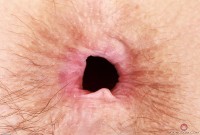 ATK hairy  in mature and hairy