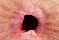 ATK hairy  in mature and hairy