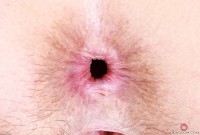 ATK hairy  in mature and hairy