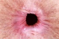 ATK hairy  in mature and hairy