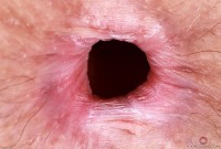 ATK hairy  in mature and hairy